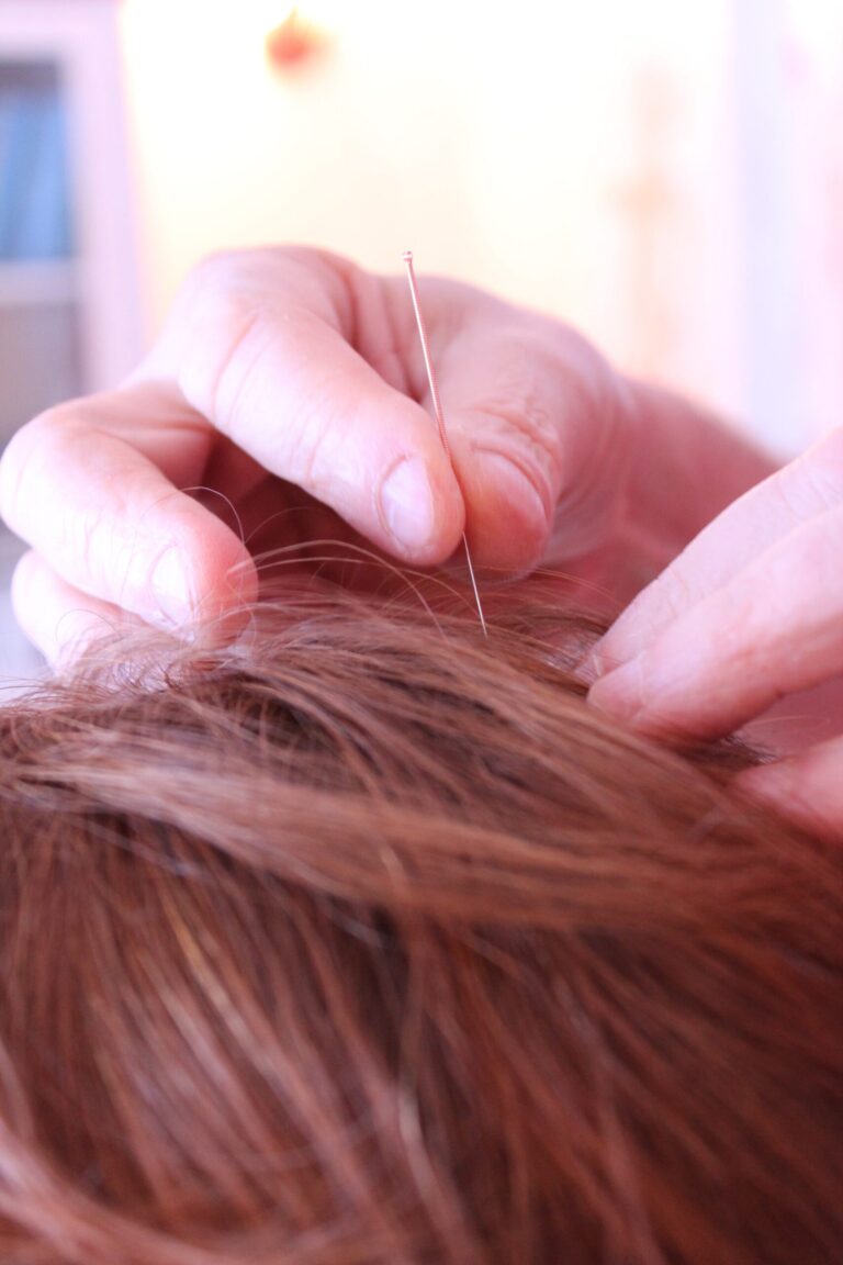 Acupuncture treatment session, background image for the best TENS unit for neuropathy